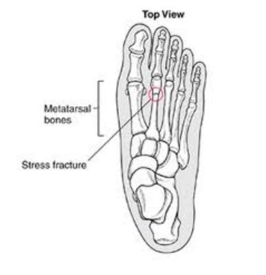 Metatarsal Stress Fracture Current Health Advice Health Blog
