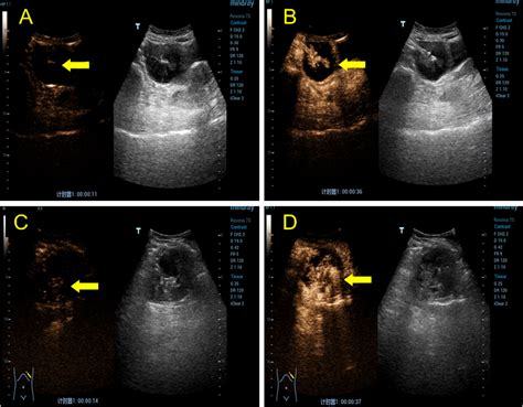 Frontiers Contrast Enhanced Ultrasonography Findings Of Lamns With