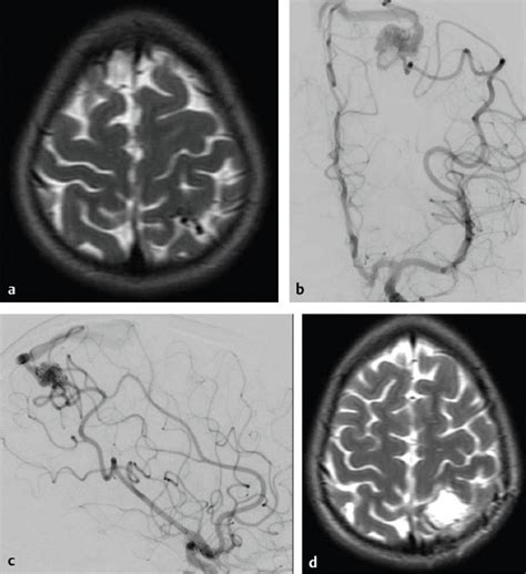 Management Of Residual And Recurrent Arteriovenous Malformations Neupsy Key