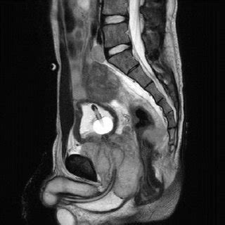 Pelvis MRI at diagnosis. | Download Scientific Diagram