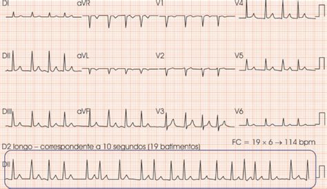 Como definir a frequência a cardíaca pelo ECG quando o ritmo cardíaco é