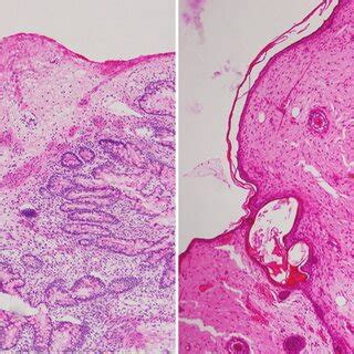 A And B Photomicrographs Of The Surgical Specimen Obtained From The