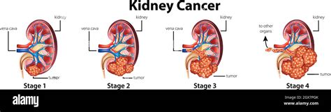 Diagramme Montrant Les Différents Stades Du Cancer Du Rein Image