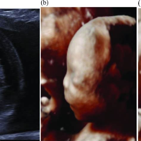 A D Ultrasound Image Of Fetal Profile Demonstrating Flat Fetal Face