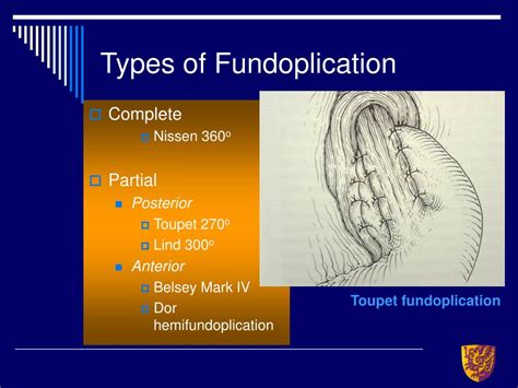 Ppt Joint Hospital Surgical Grand Round Surgical Management Of Gerd