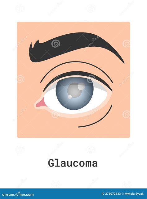 Glaucoma Human Eye Disease Vector Illustration 276072652