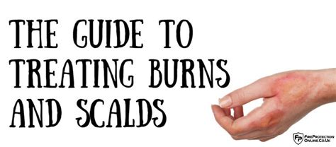 The Guide To Treating Burns And Scalds Fire Safety Information