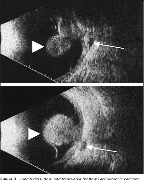 Choroidal Melanoma Ultrasound