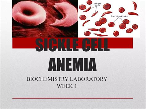 Sickle Cell Anemia Ppt 2
