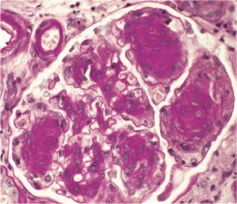 3 Glomerulus From Patient With Diabetic Glomerulosclerosis Showing