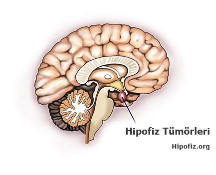 Hipofiz Mr Nedir Nasıl çekilir ve Neler İncelenir Hipofiz Bezi