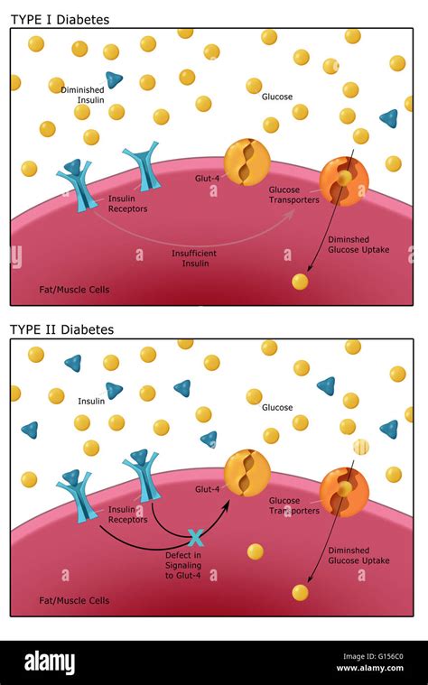 Ilustraci N Comparando La Diabetes Tipo I Arriba Donde El Cuerpo No