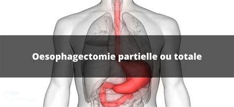 Oesophagectomie Indications Technique Complications