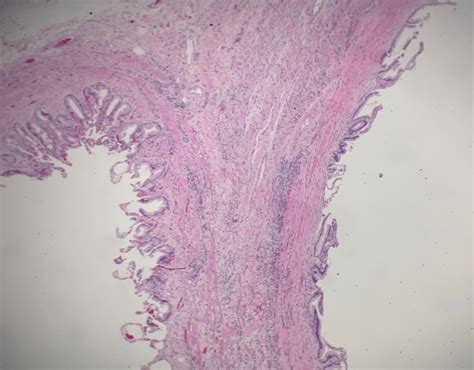 Congenitally Bilobed Gallbladder With Luminal Bile Stasis Acute On