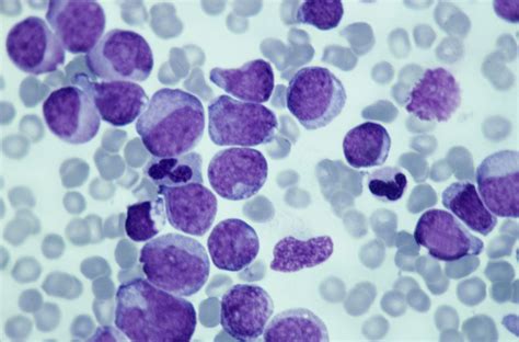 Leukemia Causes And Risk Factors