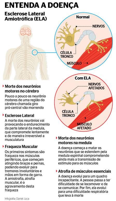 Conheça os sintomas da Esclerose Lateral Amiotrófica uma doença rara e