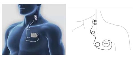 Vagus Nerve Stimulator Vns Stimulator Implanted Subcutaneously In