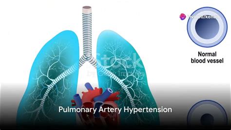 Understanding Pulmonary Circulation And Pulmonary Artery Hypertension Pah Youtube