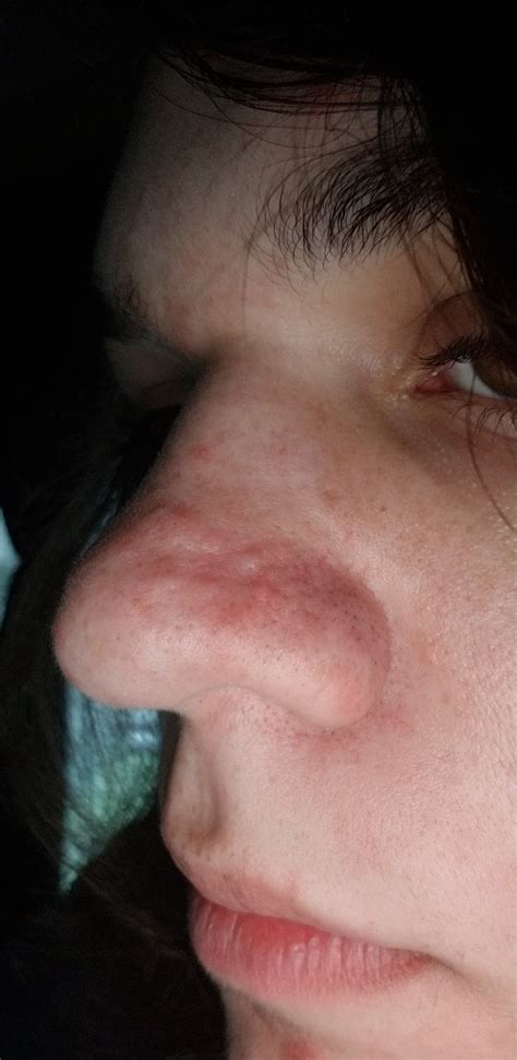 Flesh Colored Bump On Nose