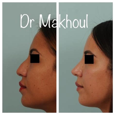 Photo Avant Apr S Rhinoplastie Ultrasonique