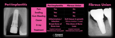 Loose Dental Implant How To Differentiate Between Bone Loss From