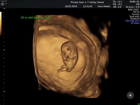 Early Pregnancy Scan Private Ultrasound Scans London