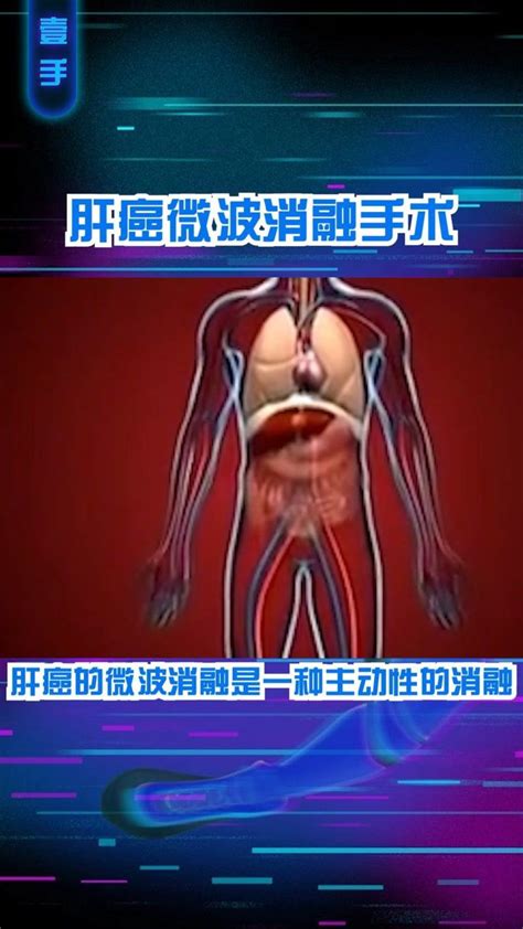 3d医学视频：肝癌微波消融手术！高清1080p在线观看平台腾讯视频