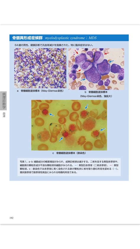 drummer toshi on Twitter RT K9FCR 骨髄異形成症候群 myelodysplastic syndrome