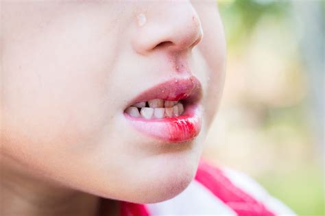 Las Emergencias Dentales Más Comunes Y Qué Hacer Cuando Ocurren