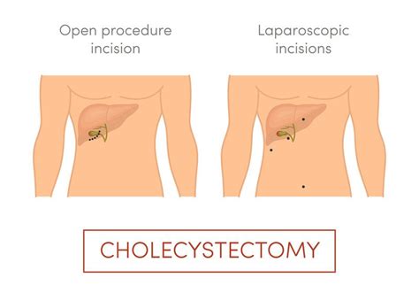 Cholecystectomy Guide