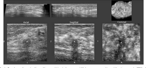 Figure 1 From Computerized Detection Of Breast Cancer On Automated