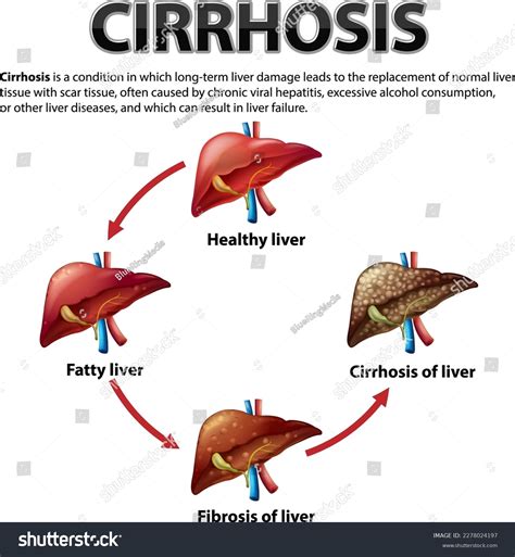 Informative Poster Alcoholic Liver Disease Cirrhosis Stock Vector ...