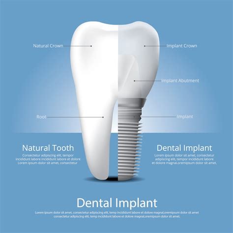 Dientes humanos e implantes dentales ilustración vectorial Vector Premium