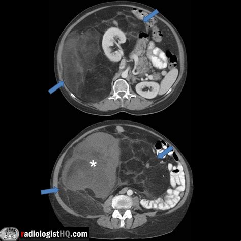 Massive Abdominal Liposarcoma Blue Arrows Surrounding Right Kidney On