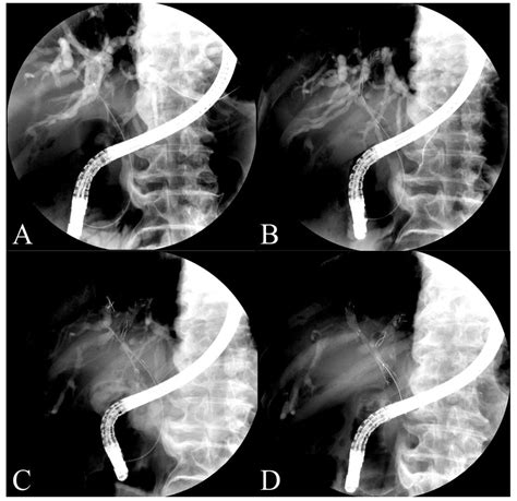 Bile Duct Stent Survival Rates