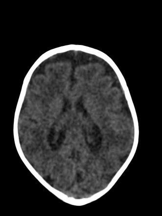 Microcephaly With A Simplified Gyral Pattern Radiology Reference