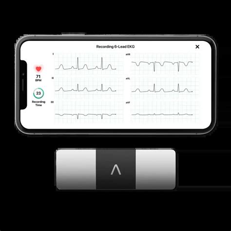 Kardiamobile 6L: Revolutionizing Heart Health Monitoring