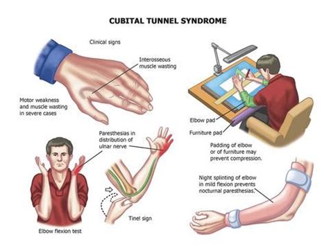 Medical School Cubital Tunnel Syndrome What To Know Cubital Tunnel