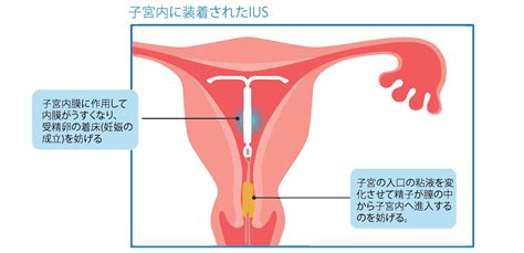 Iusによる避妊 避妊のススメ