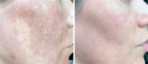 Hyperpigmentation And Melasma My Perfect Skin Clinic