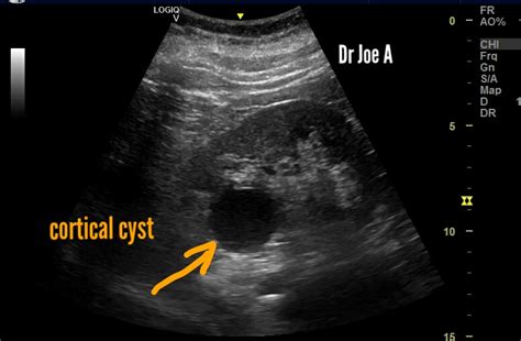 Hemorrhagic Renal Cyst Ultrasound