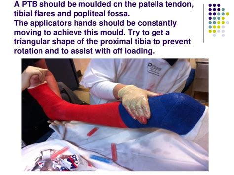 Patellar Tendon Bearing Cast