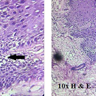 Histopathology image (H & E stain) at 10× magnification showing ...