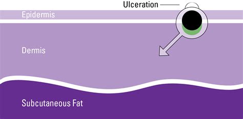 Stages Of Melanoma Aim At Melanoma Foundation