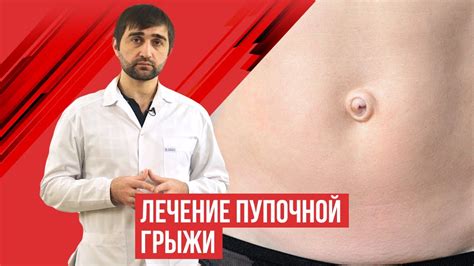 Лечение пупочной грыжи народными средствами