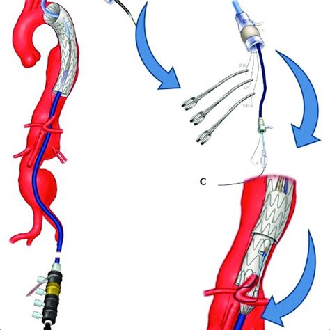 Patient Characteristics Of 564 Patients Undergoing Fenestratedbranched Download Scientific