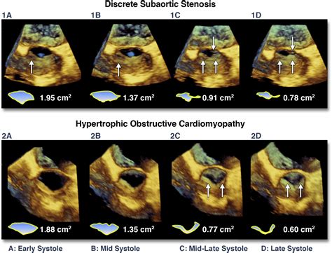 Lv Outflow Tract Area In Discrete Subaortic Stenosis And Hypertrophic