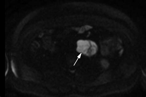 Testicular Seminoma And Its Mimics From The Radiologic Pathology