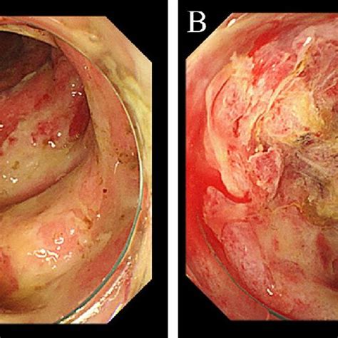 A Emergency Colonoscopy Revealed Extensive Mucosal Erosions In The