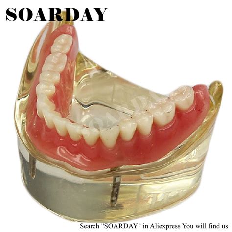 Soarday Dental Lower Removable Overdenture Inferior With 2 Implants